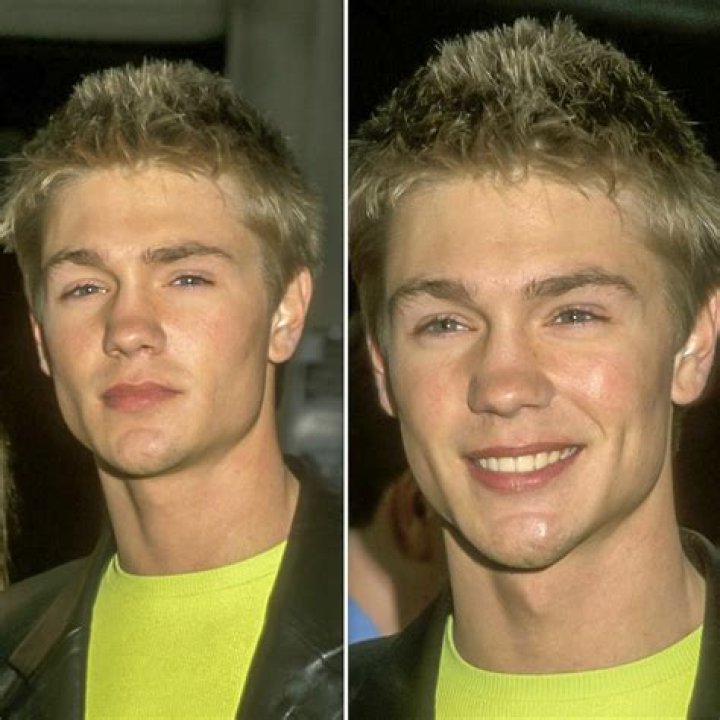 Chad Michael Murray's Surgery: Before And After