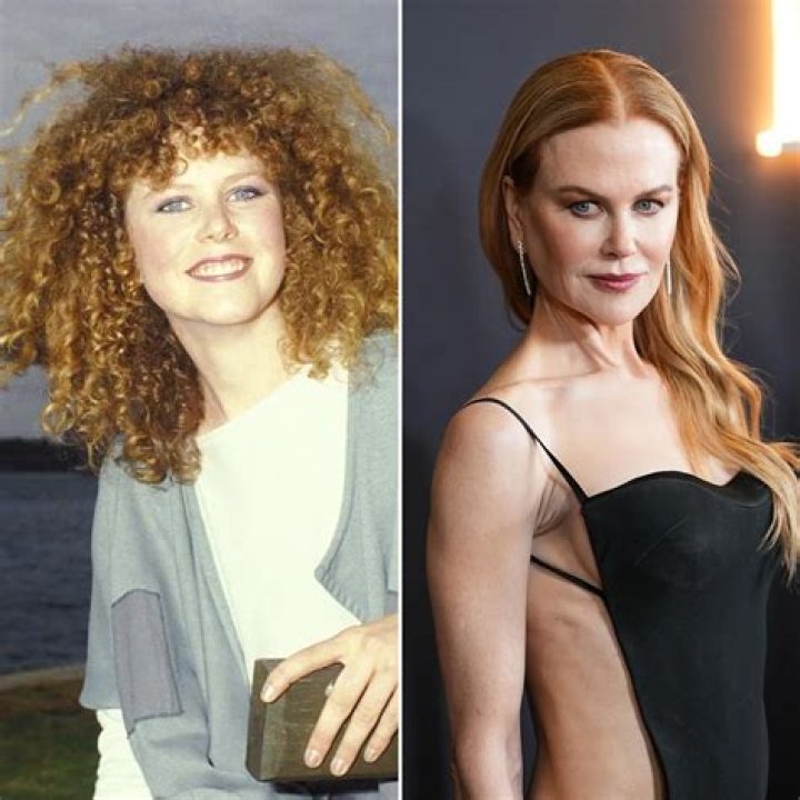 Discover Nicole Kidman's Surgery Journey: Before And After