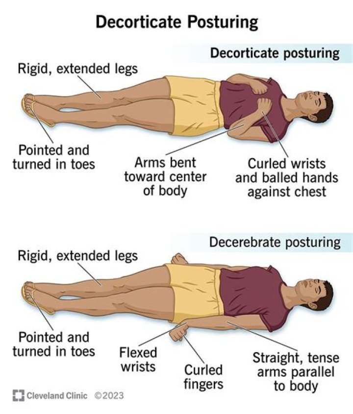 Do contractures go away?