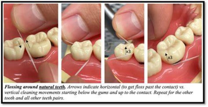 Does flossing prevent root canals?