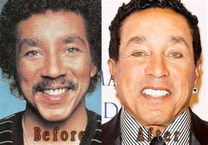 Has Smokey Robinson Had Plastic Surgery