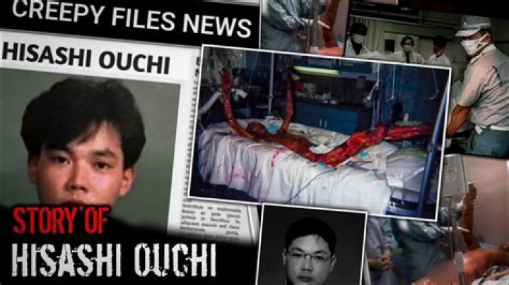 Hisashi Ouchi: The True Story Of His Horrific Accident