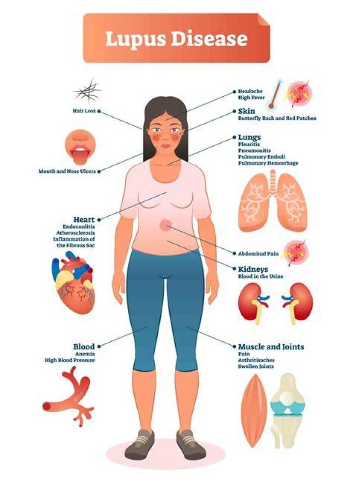 How do I know if I have lupus on my kidneys?