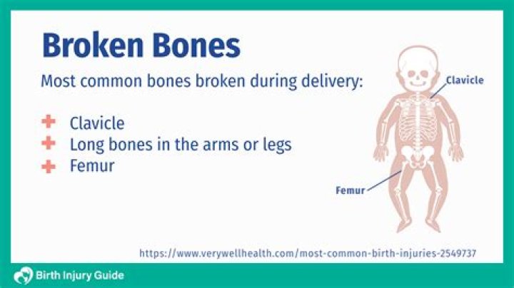 How many bones are broken during childbirth?