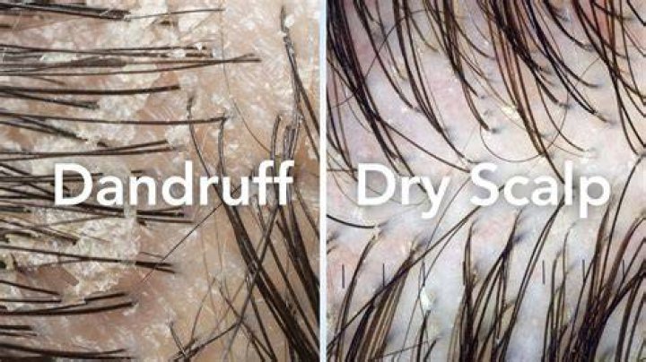 Is soft water good for dandruff?