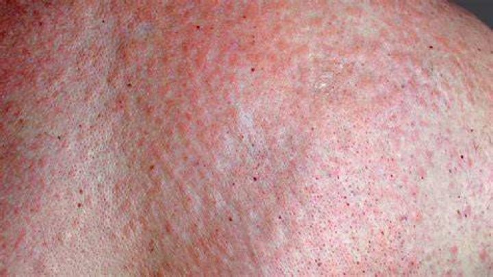 What does kidney rash look like?