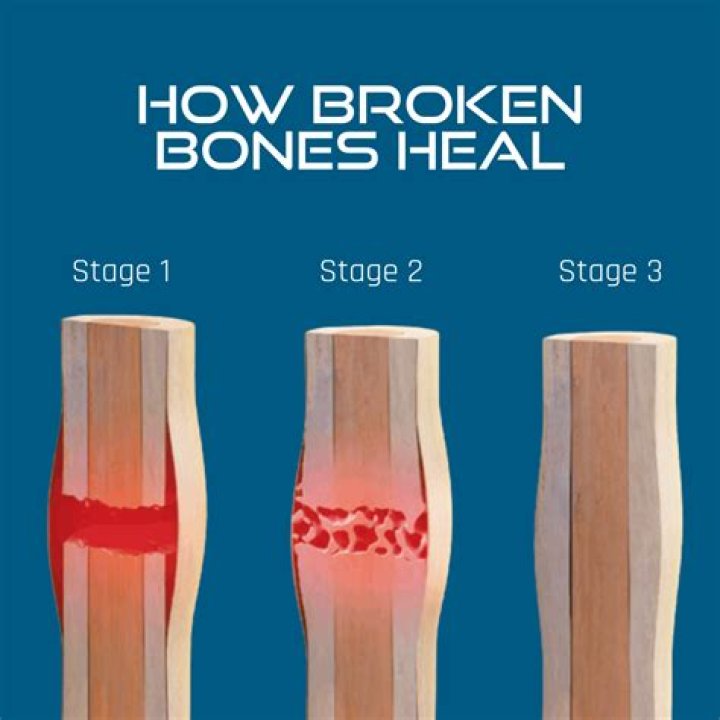 What helps broken bones heal faster?