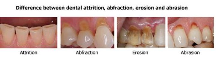 What is the difference between attrition and bruxism?