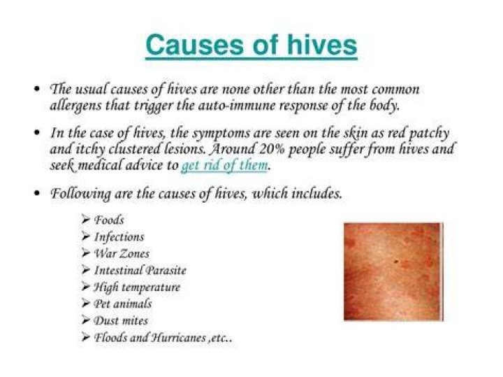 What viruses cause hives?