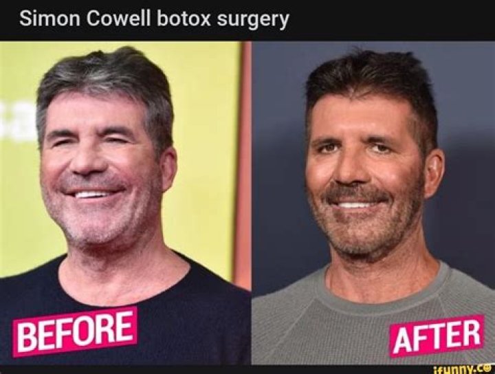 What You Need To Know About Simon Cowell's Eye Surgery