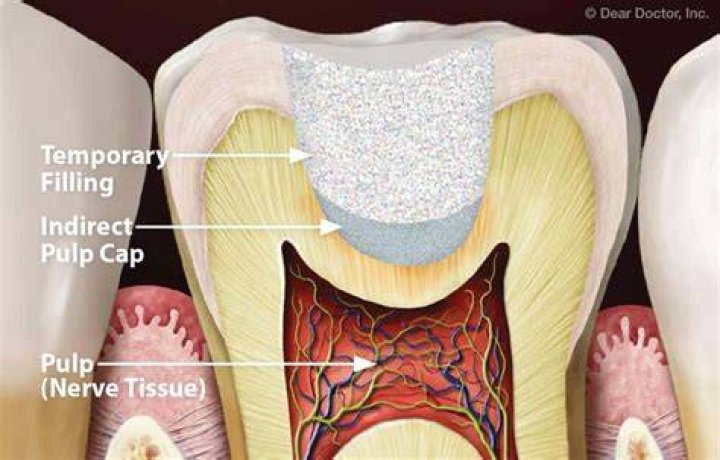 When do you use indirect pulp cap?